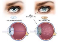 Câu chuyện thần kỳ - Sự kỳ diệu của nước dừa với đôi mắt ( bệnh cườm mắt và đục nhân mắt )
